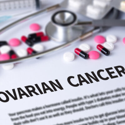 An overview of ovarian cancer