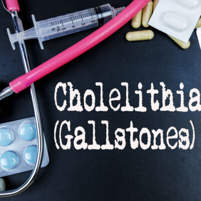 The causes, symptoms, and treatment for gallstones