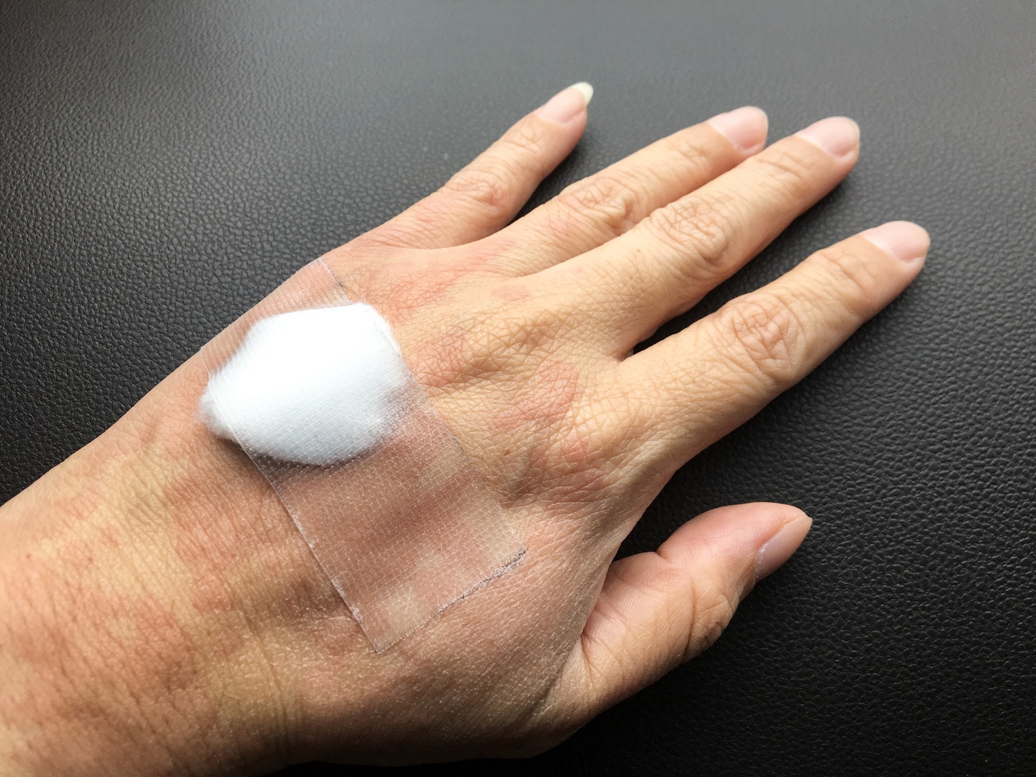 Effective home remedies for hives