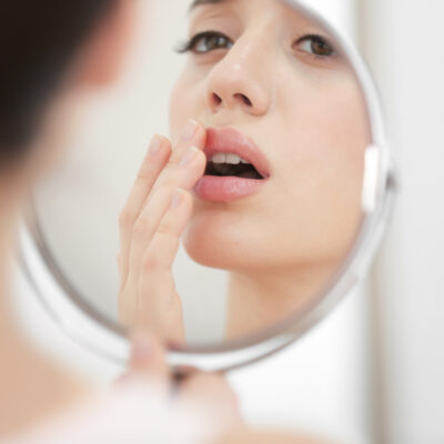 Cold Sore Prevention Tips